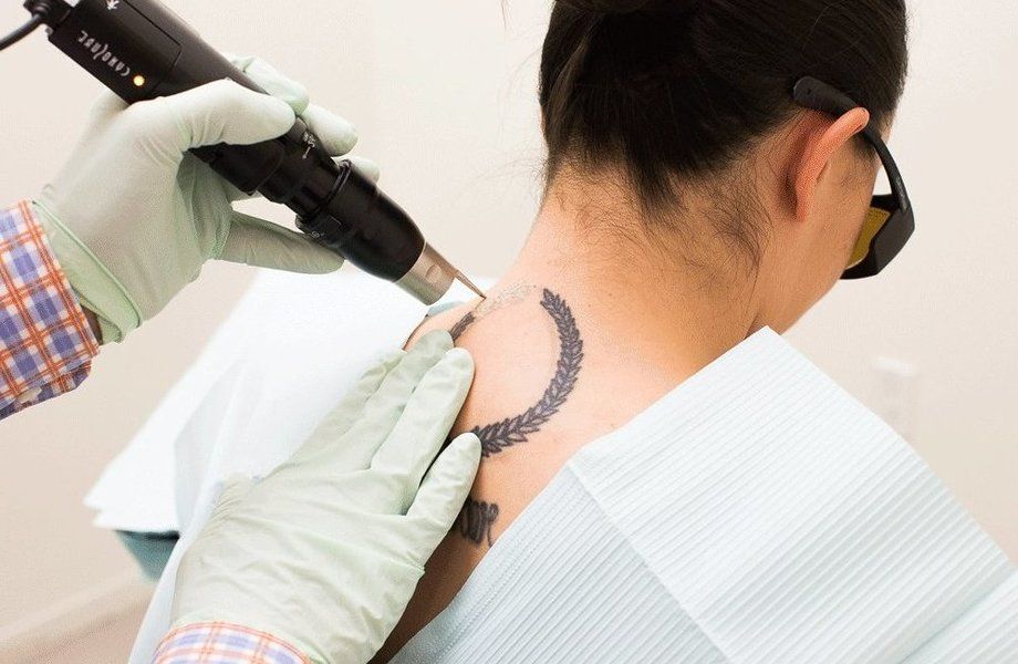 Бизнес по удалению татуировок с большой клиентской базой